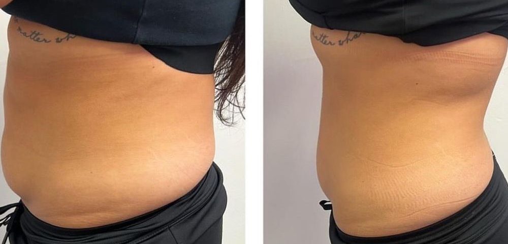 kybella montebello ca