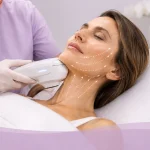 HIFU vs Ultherapy